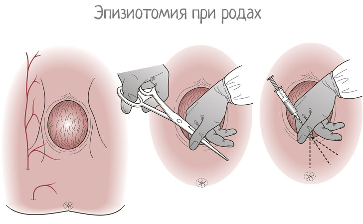 эпизиотомия во время родов