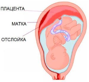 отслойка плаценты при беременности